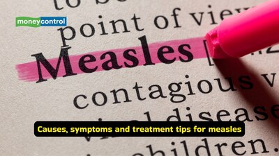 Symptoms of measles: Persistent cough, nasal congestion and red, watery eyes (conjunctivitis) are classic early symptoms. These signs can manifest before the rash (Image: Canva)