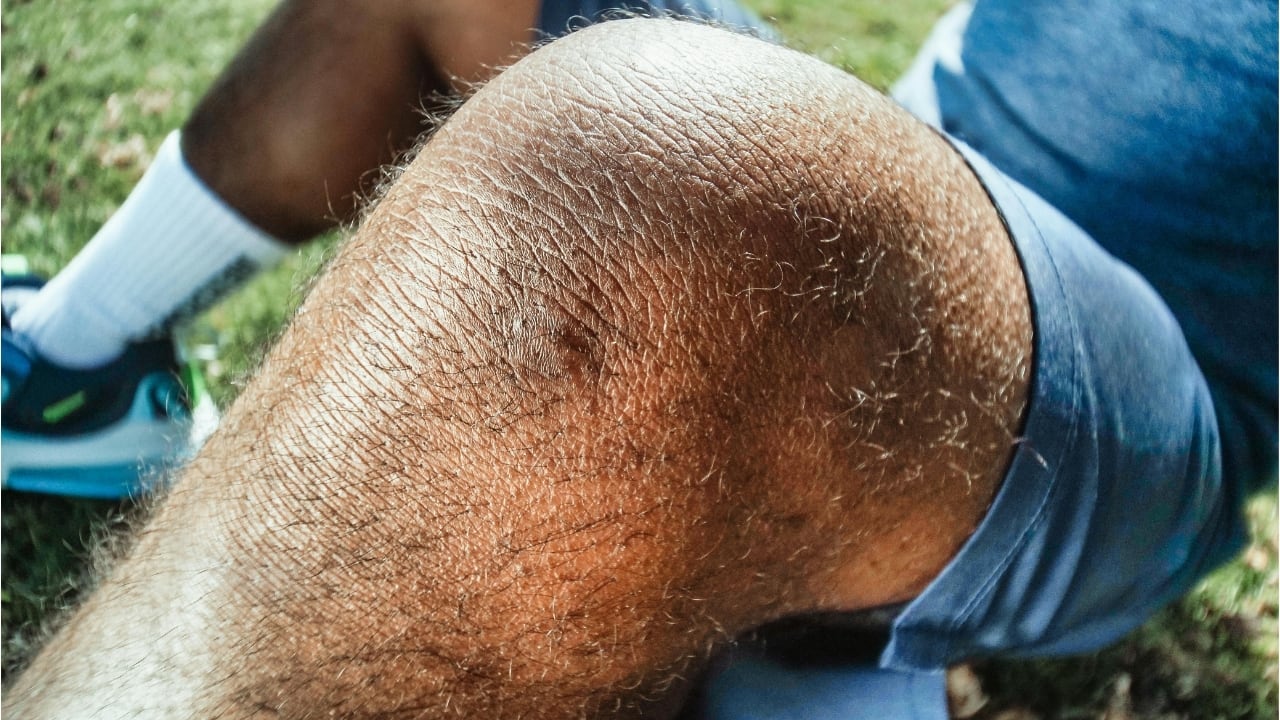 What is Acanthosis nigricans? Causes, symptoms and home remedies for black patches on neck, armpits, elbows