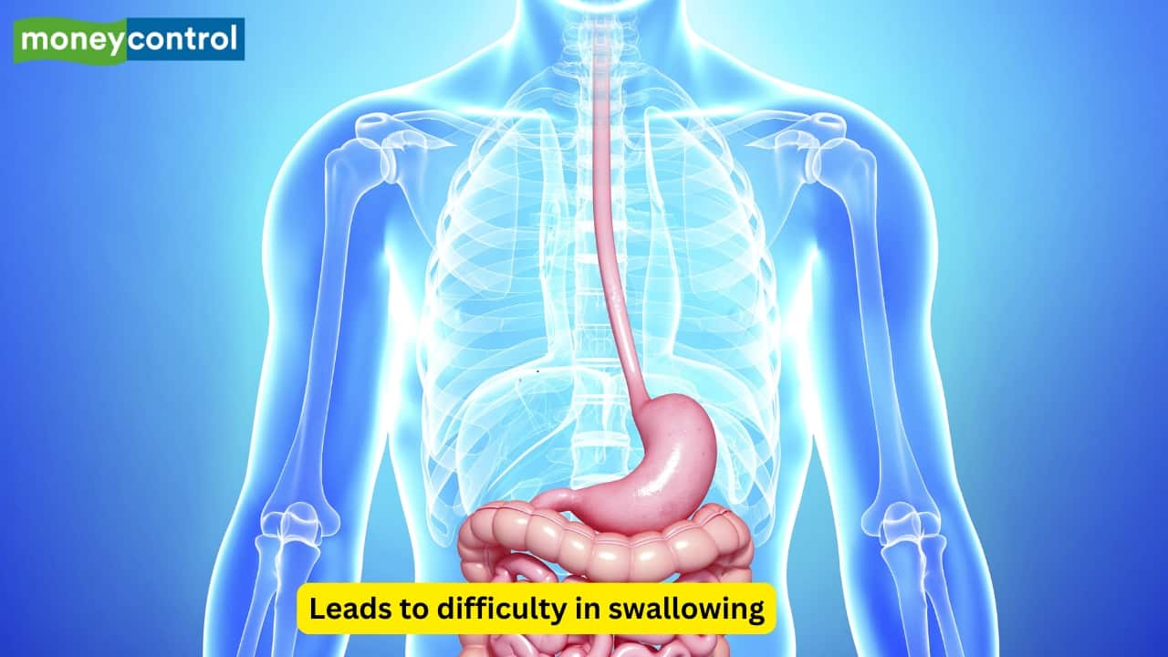 Esophageal Malignancy Smoking damages the esophageal lining and promotes malignant transformation, increasing the risk of esophageal cancer. Common symptoms include dysphagia, chest pain, and progressive weight loss. 