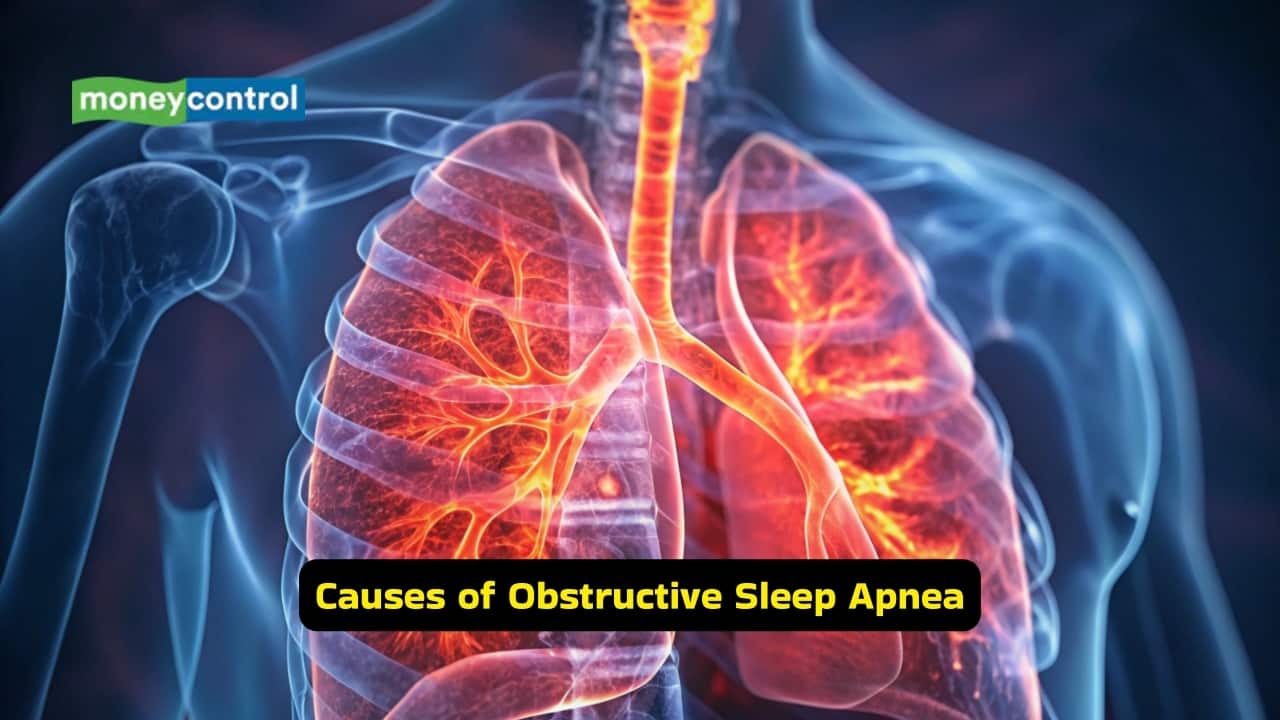 Causes of Obstructive Sleep Apnea This condition occurs due to the collapse of the upper airway during sleep, most commonly at the level of the pharynx. Reduced tone of the pharyngeal muscles during sleep contributes to airway obstruction. Structural or anatomical narrowing of the airway also plays an important role in disease development.