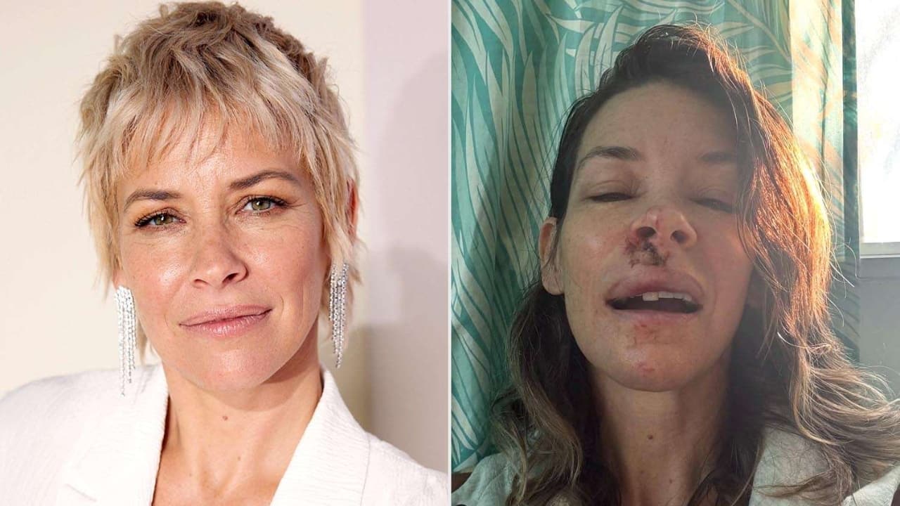 Evangeline Lilly reveals she has brain damage months after concussion, opens up about ongoing recovery
