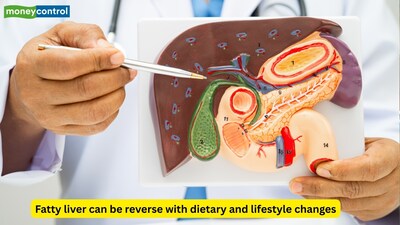 Poor diets, heavy drinking and obesity often cause fatty liver disease. (Picture Credit: Canva)