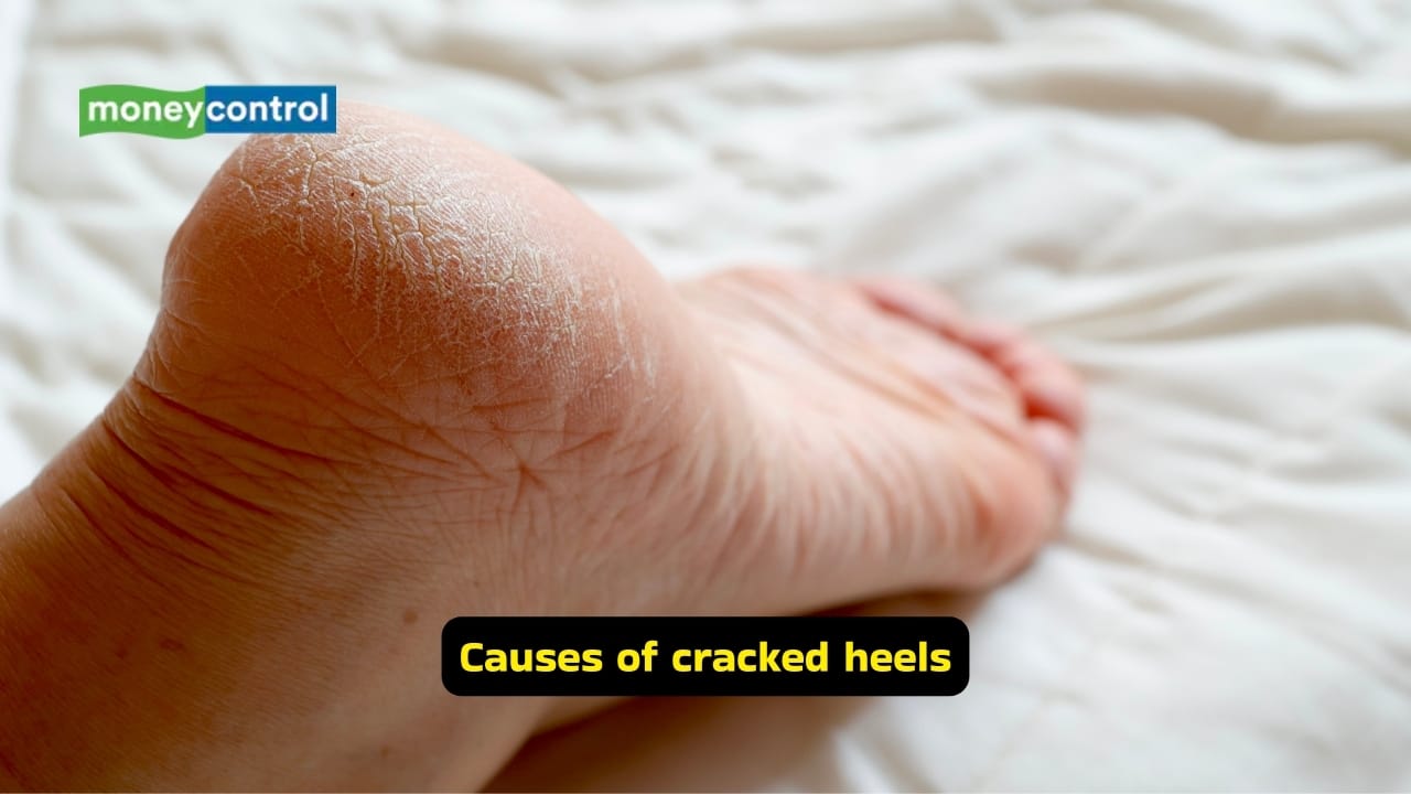 Home remedies to cure cracked heels in winter, stop pain and infection
