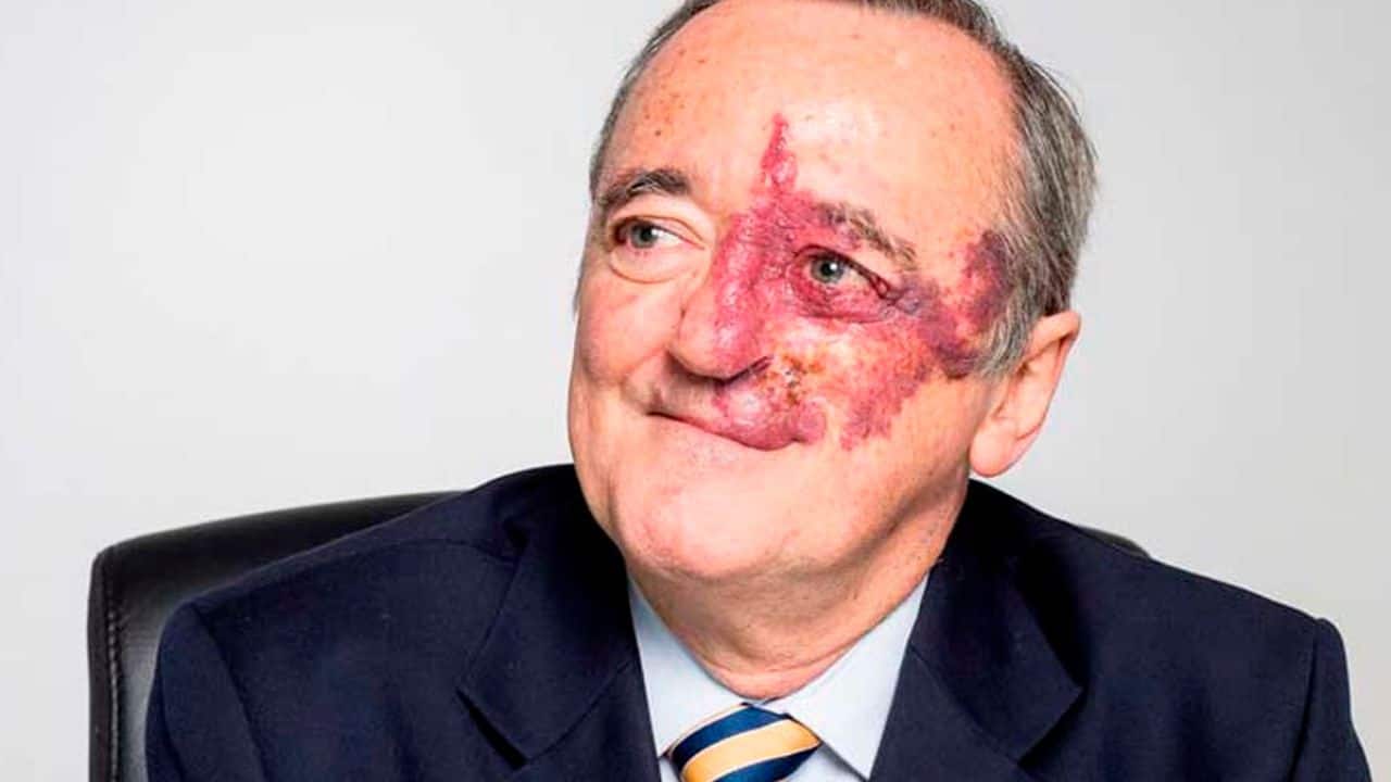 Mariano Barbacid achieves pancreatic cancer cure in mice, but social media mocks his facial mark