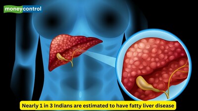 A doctor says Indians are far more likely to develop fatty liver disease, almost three times more than many other ethnicities. (Picture Credit: Canva)