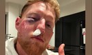Ben Stokes suffers gruesome facial injury, posts photo of swollen and bruised right eye on Instagram