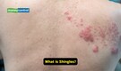 GSK study flags low Shingles awareness among older Indians despite rising risk