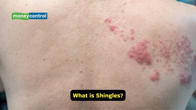 Symptoms of shingles: Shingles triggers inflammation that can irritate blood vessels and increase the risk of heart attacks or strokes (Image: Canva)