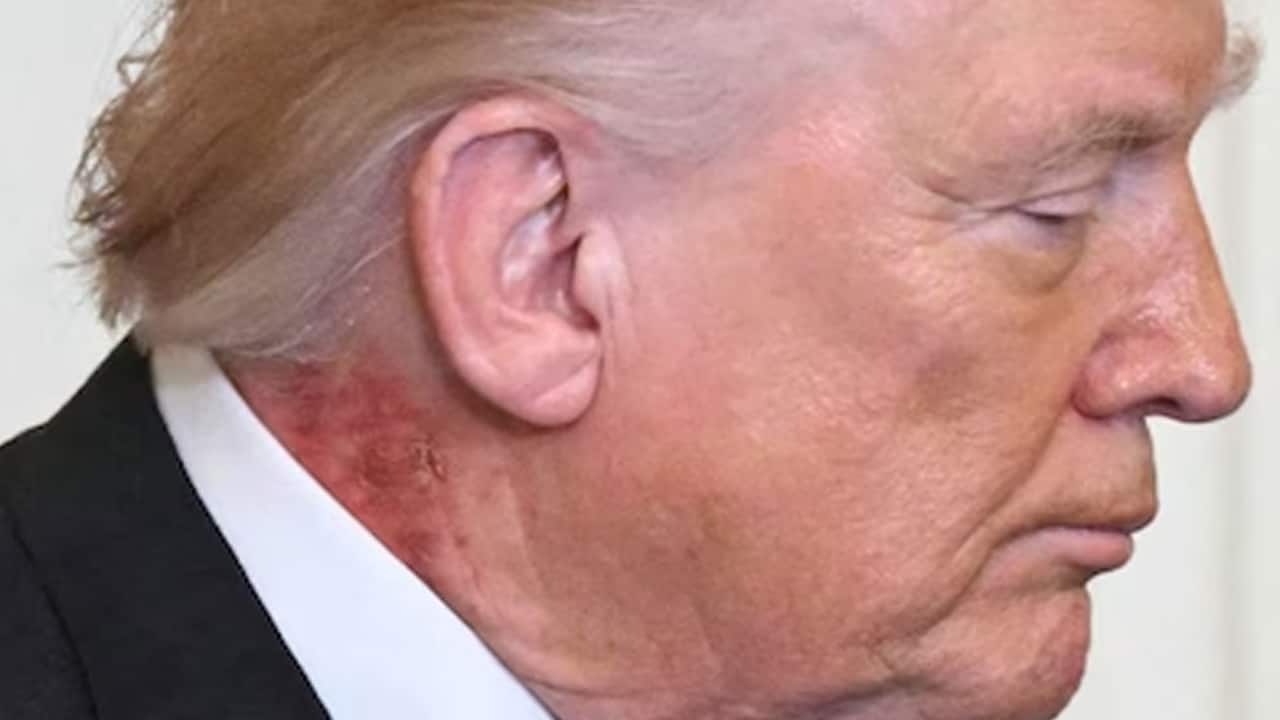 What we know about the neck rash seen on President Trump