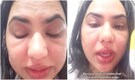 Blinkit customer says free Dot & Key cream made her face swell: ‘Had to take leave from work’