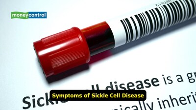 Symptoms of Sickle Cell Disease: In sickle Cell disease, red blood cells change shape. Instead of being round, they become curved and stiff (Image: Canva)
