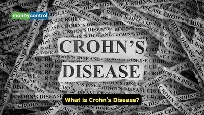 Crohn’s disease, a chronic condition of the digestive tract, is known for its unpredictable and often debilitating symptoms that include abdominal pain, diarrhoea, fatigue, and weight loss (Image: Canva)