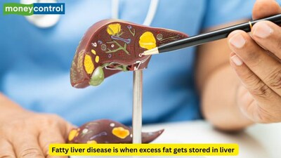 7 factors that increase fatty liver risk in women, from insulin resistance to PCOS, more