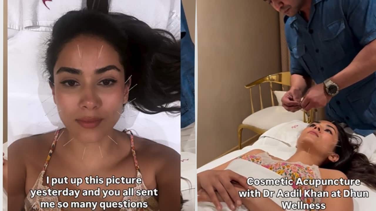 Mira Rajput's Cosmetic Acupuncture: Celebrity Skincare Power Move